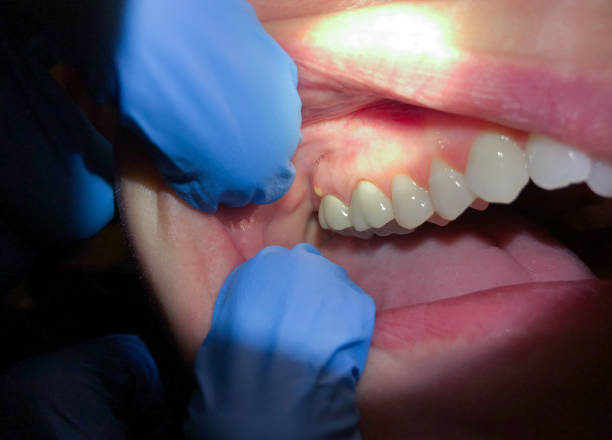 Best Knocked-Out Tooth (Avulsed Tooth) Treatment in Crosby, TX